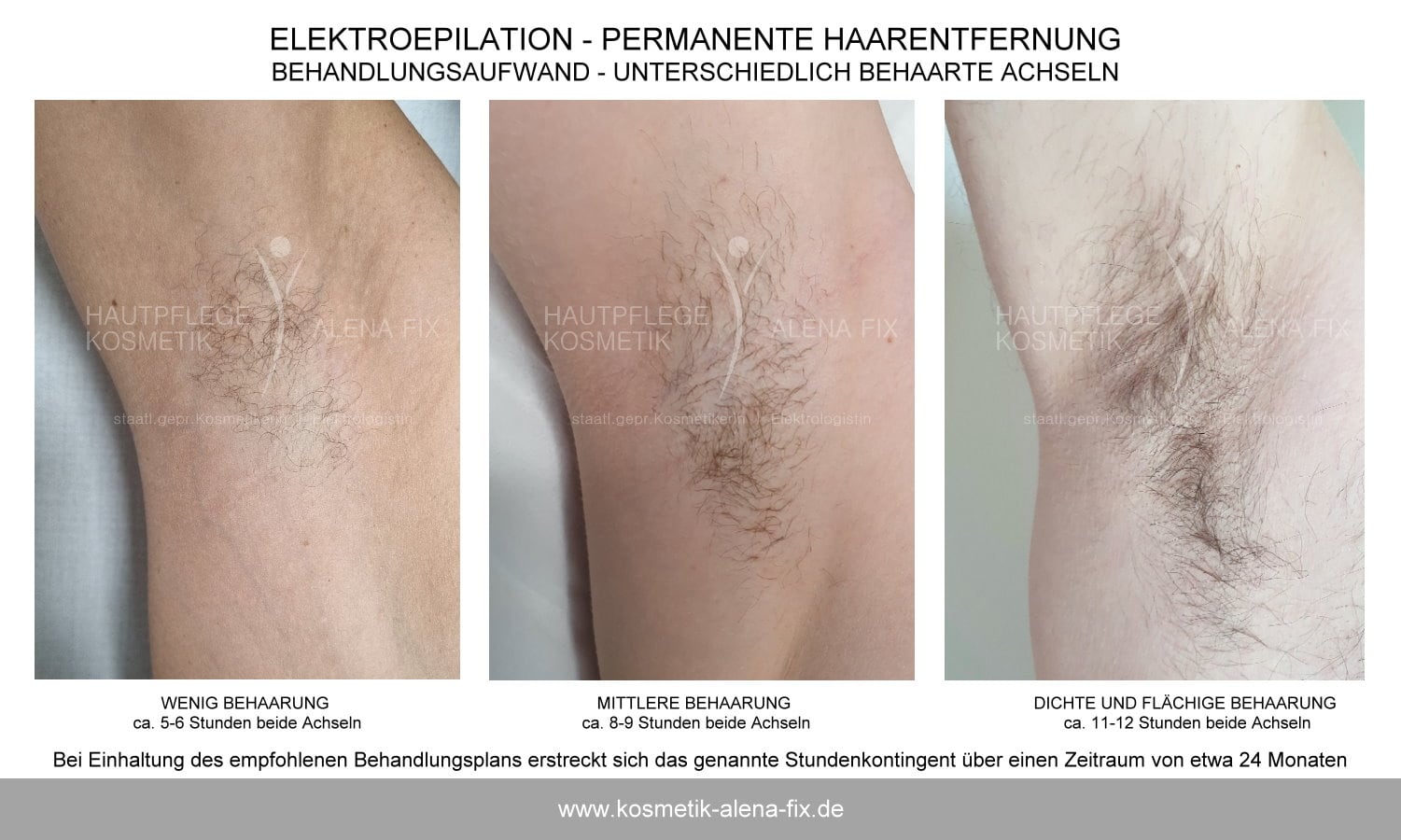 Elektroepilation Achsel Erfahrungen