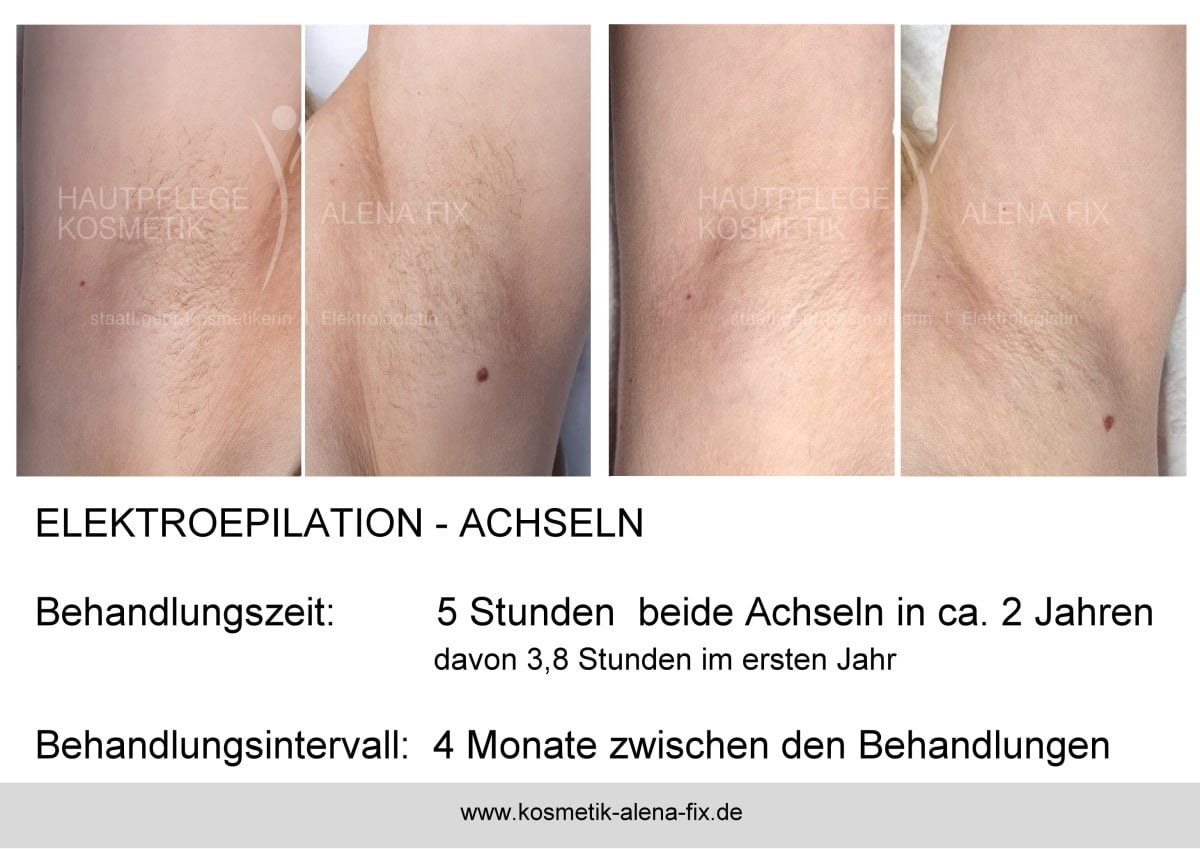 Elektroepilation Achseln vorher nachher