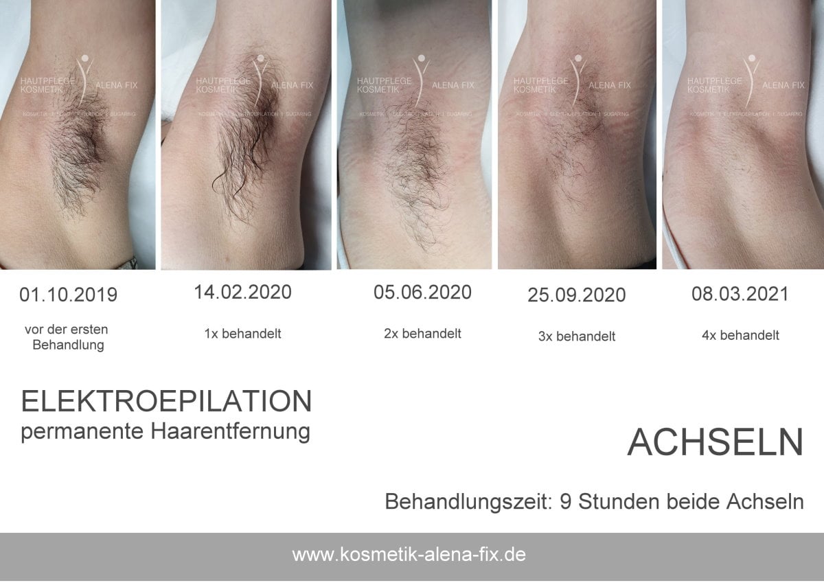 Elektroepilation Achseln vorher nachher