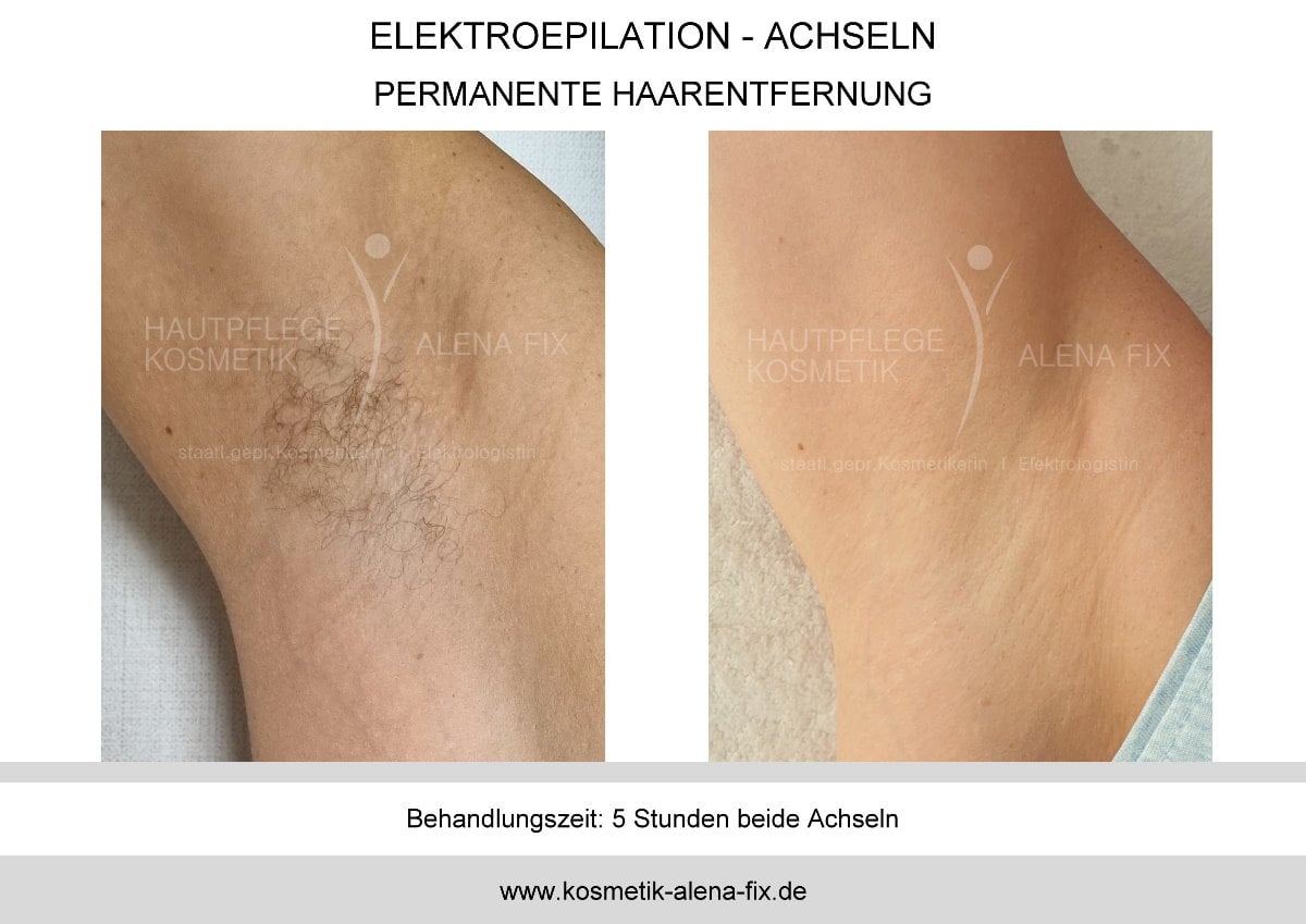 Elektroepilation Achseln vorher nachher