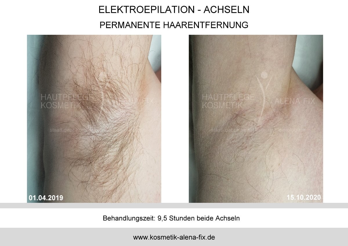 Elektroepilation Achseln vorher nachher