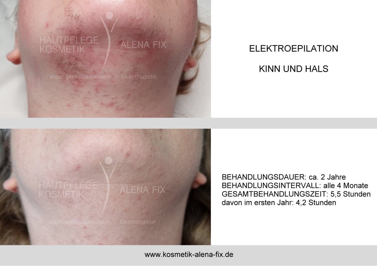 Elektroepilation Gesicht vorher nachher