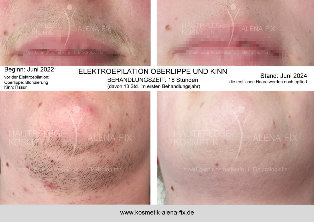 Elektroepilation Gesicht vorher nachher