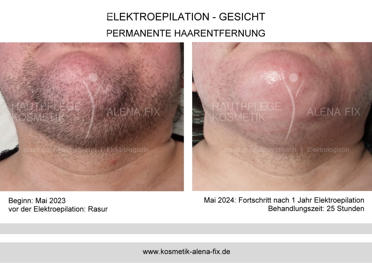 Elektroepilation Gesicht vorher nachher