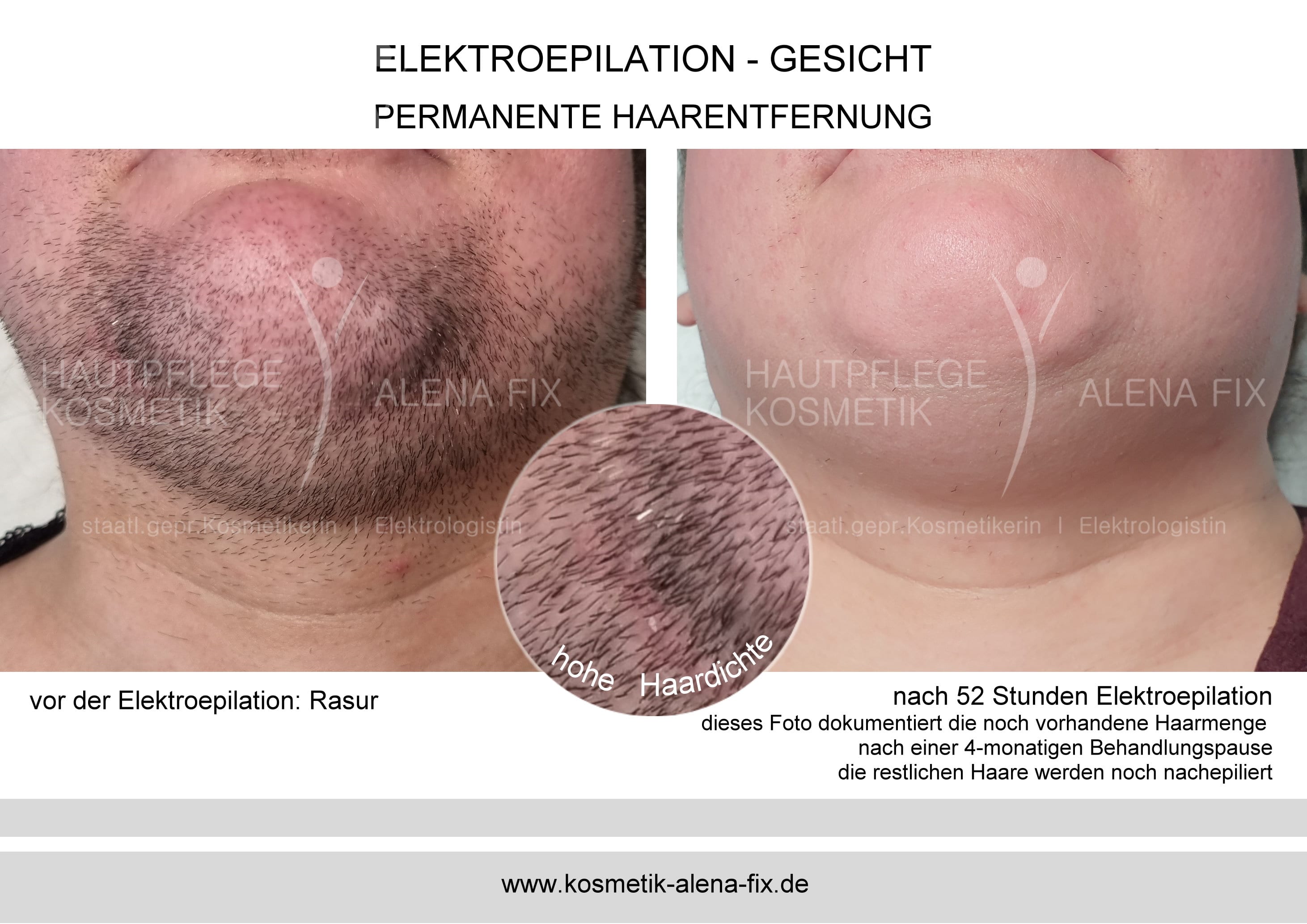 Elektroepilation Gesicht vorher nachher