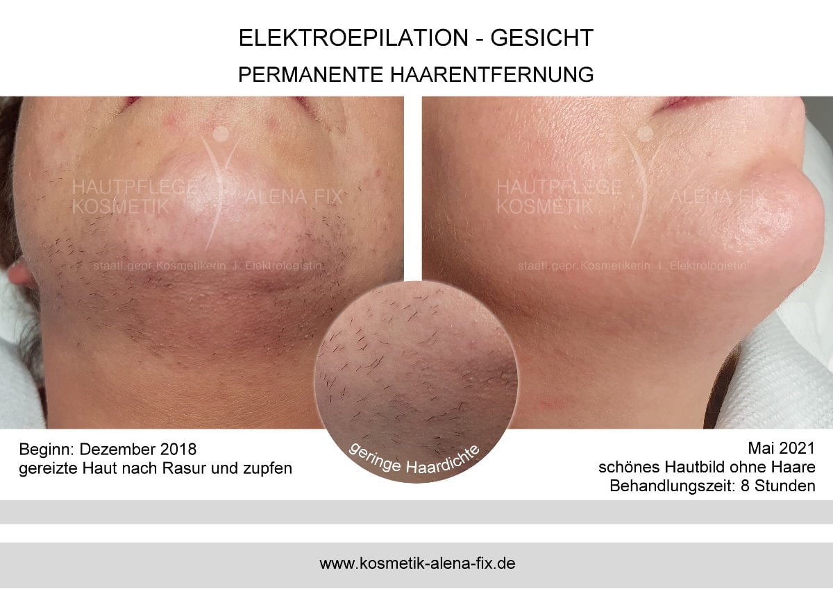 Elektroepilation Gesicht vorher nachher