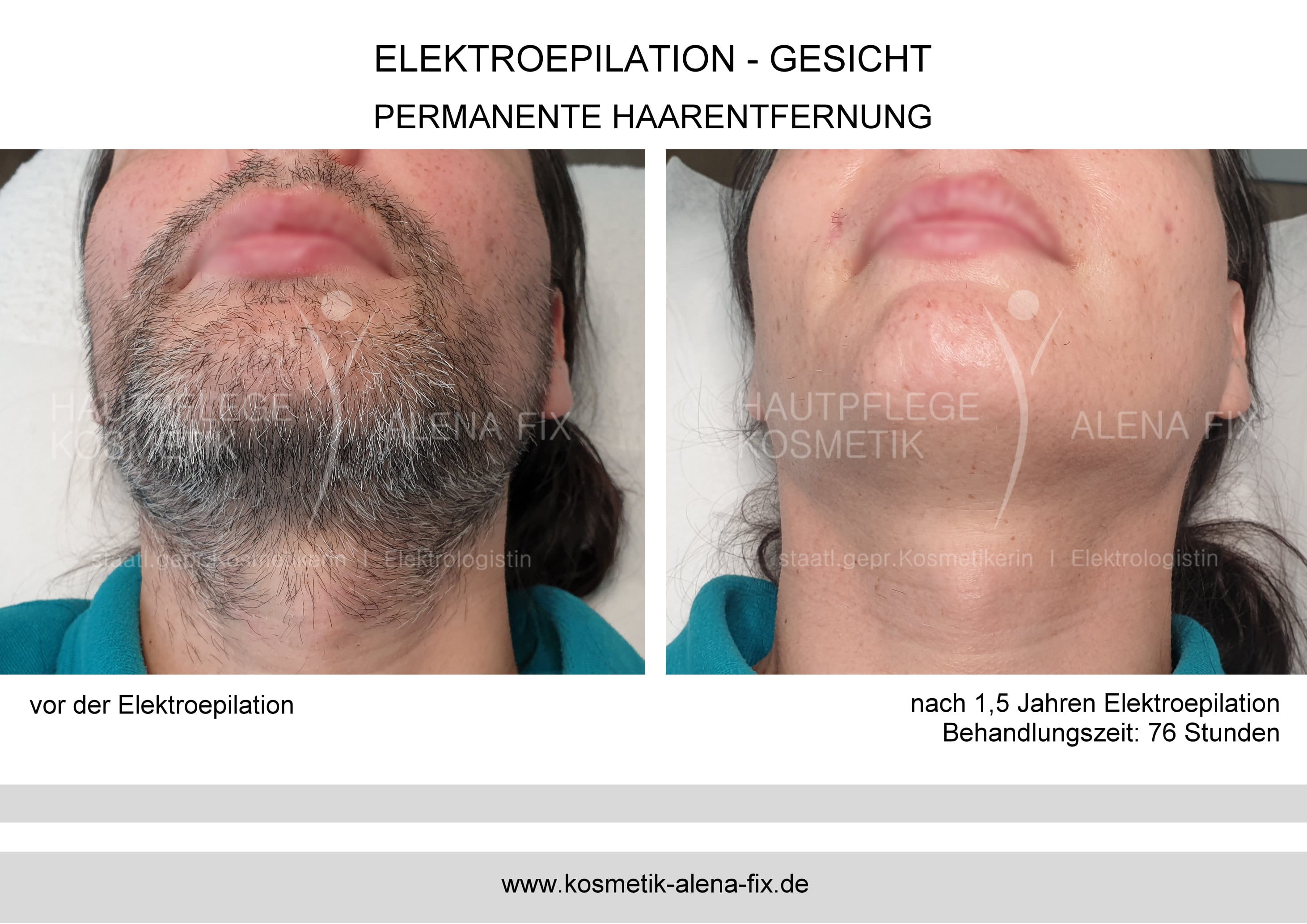 Elektroepilation Gesicht vorher nachher