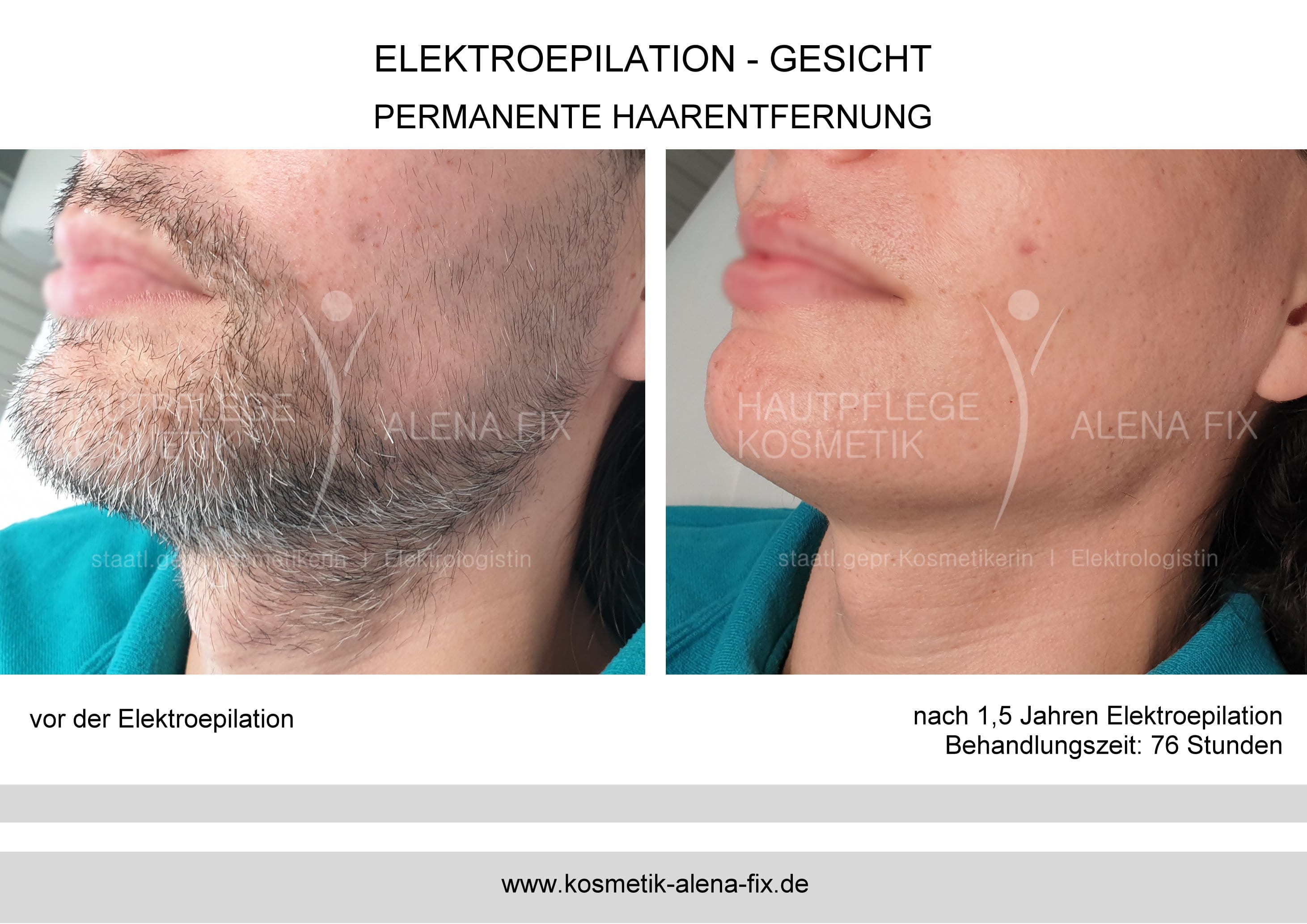 Elektroepilation Gesicht vorher nachher