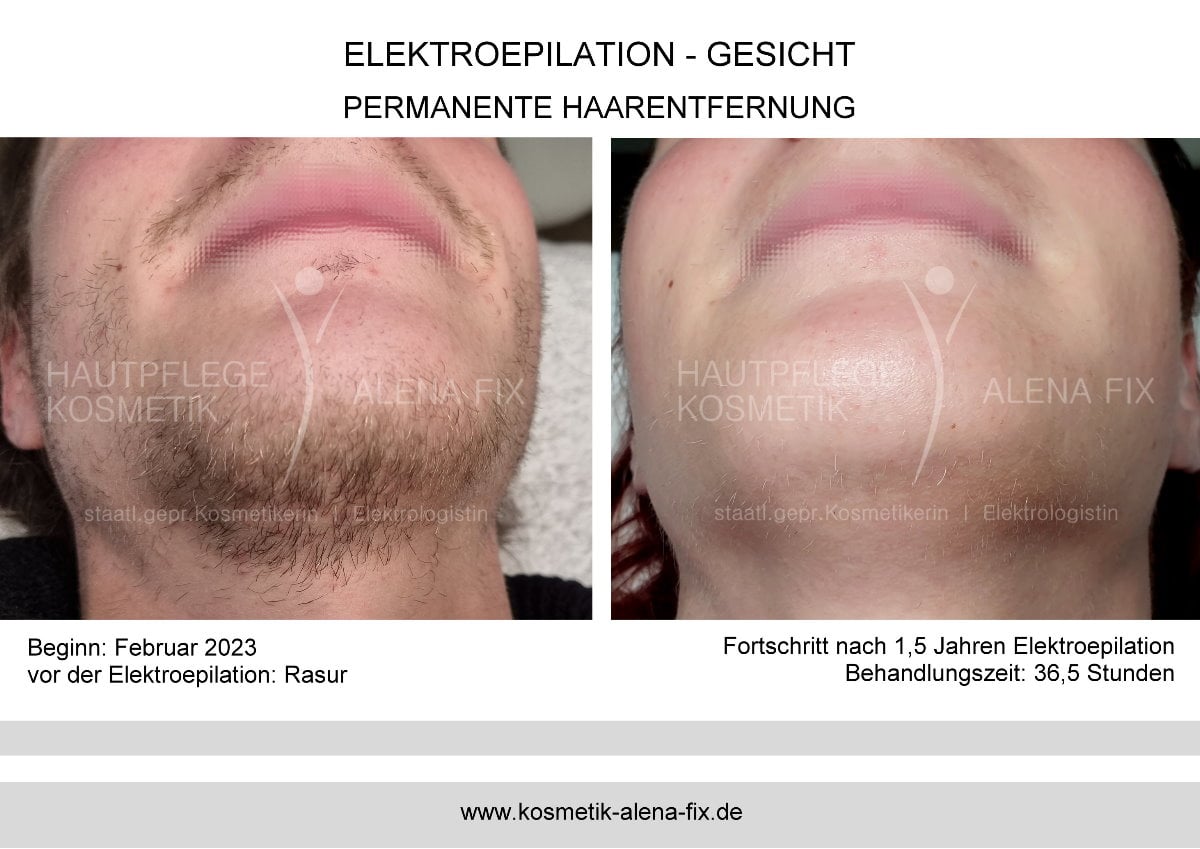 Elektroepilation Gesicht vorher nachher