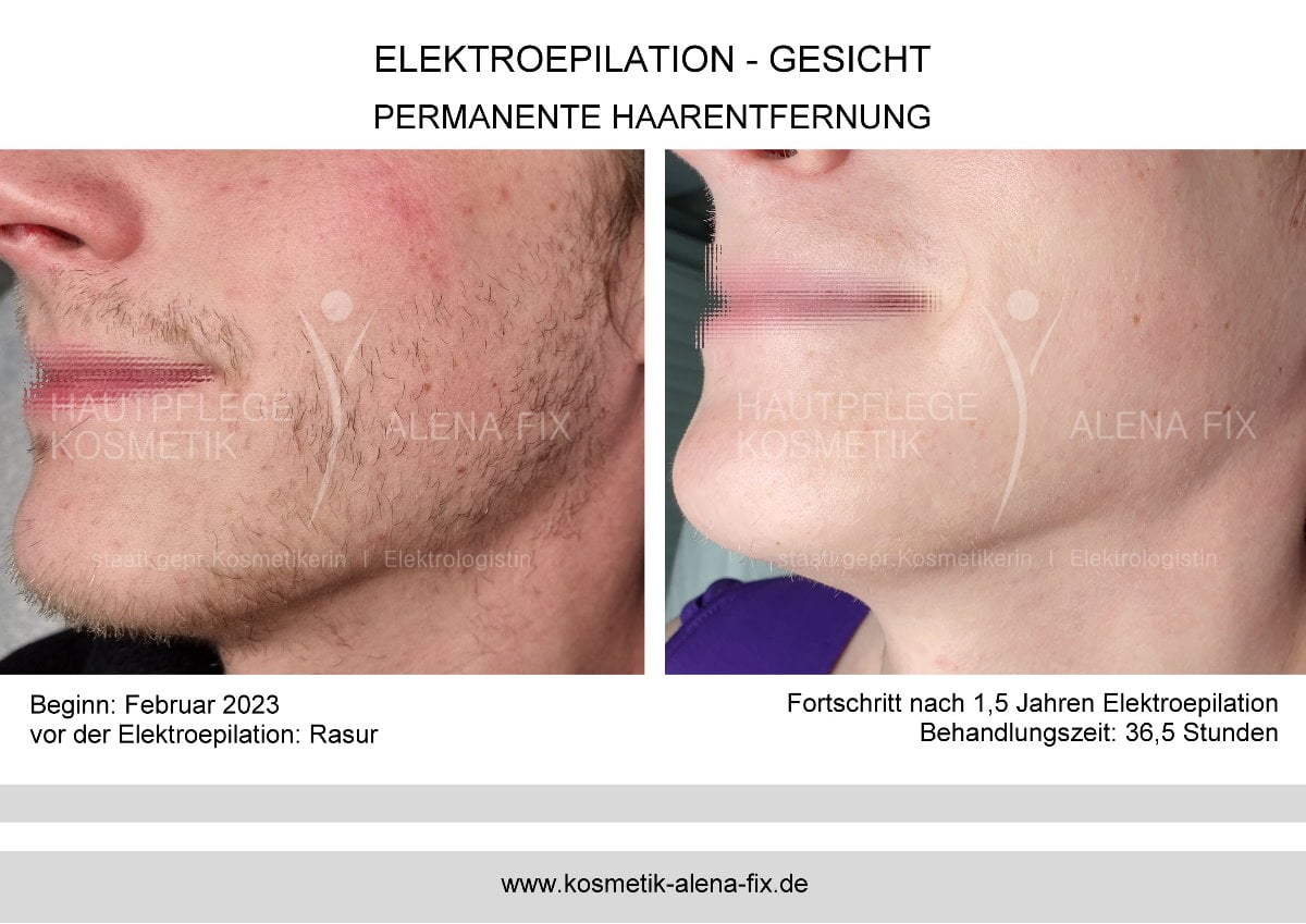 Elektroepilation Gesicht vorher nachher
