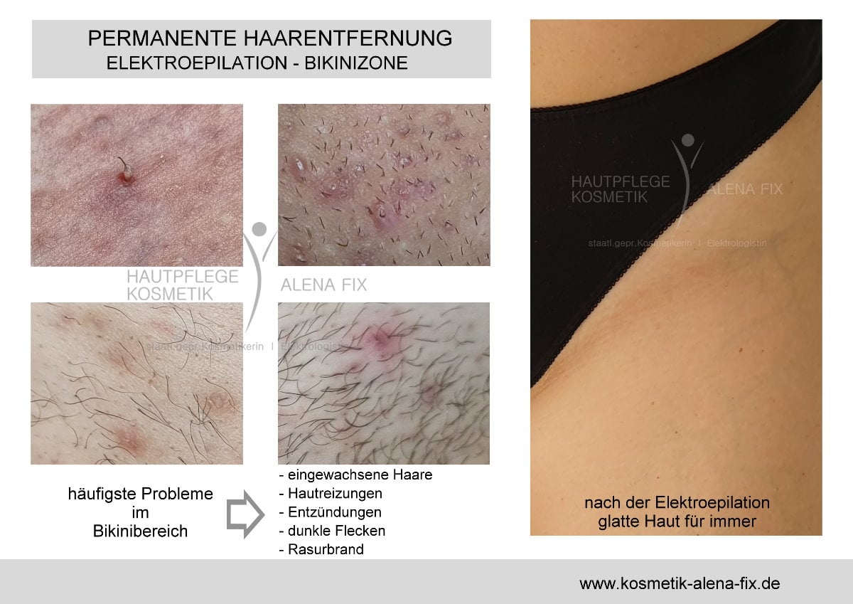 Elektroepilation Bikinizone vorher nachher