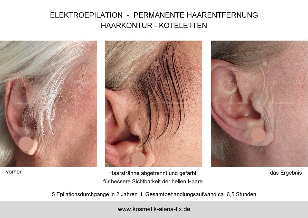 Elektroepilation Gesicht vorher nachher Gesicht