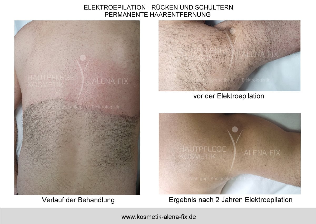 Elektroepilation Rücken vorher nachher