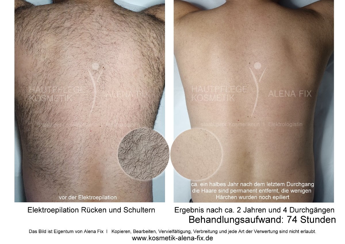 Elektroepilation Rücken vorher nachher