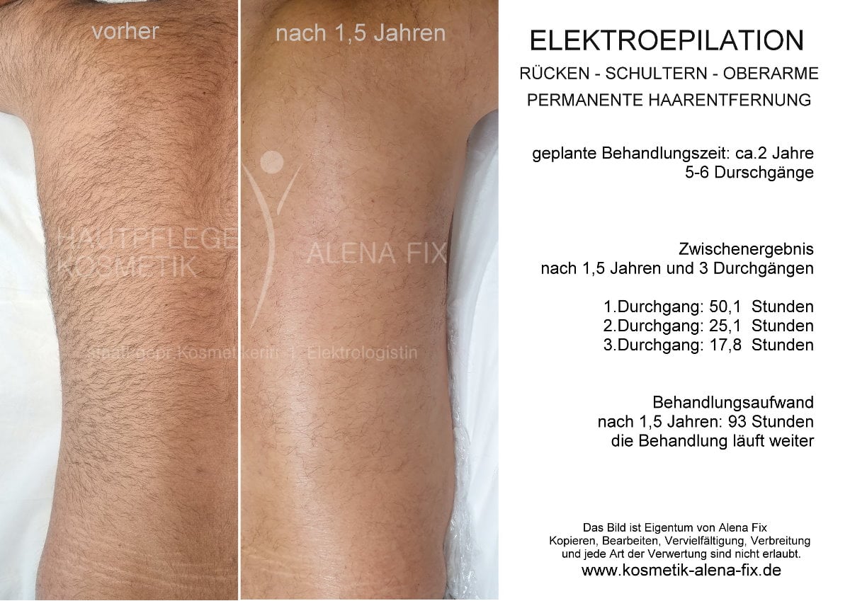 Elektroepilation Rücken vorher nachher