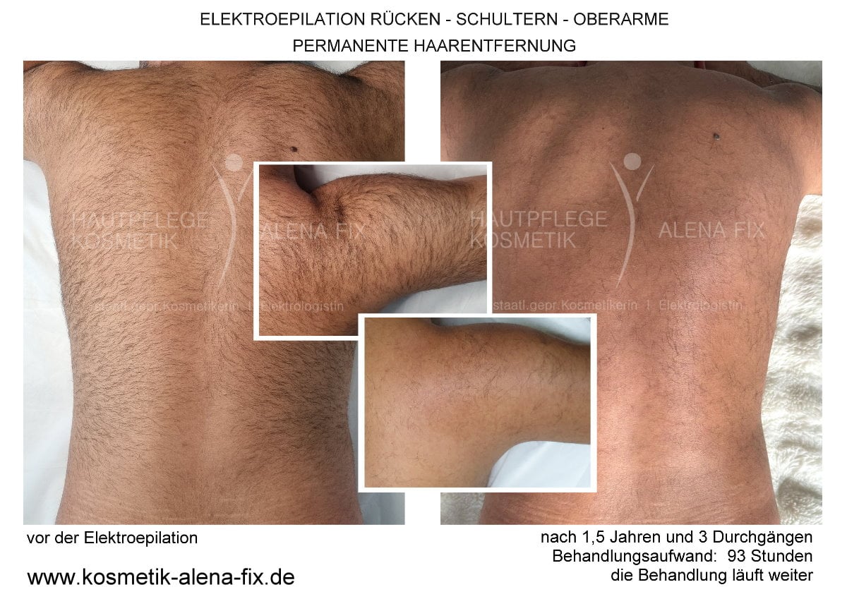 Elektroepilation Rücken vorher nachher